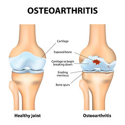 Osteoarthritis Treatment in Tampa