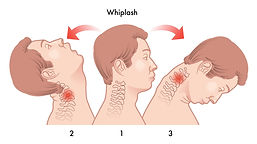 Whiplash Treatment in Tampa